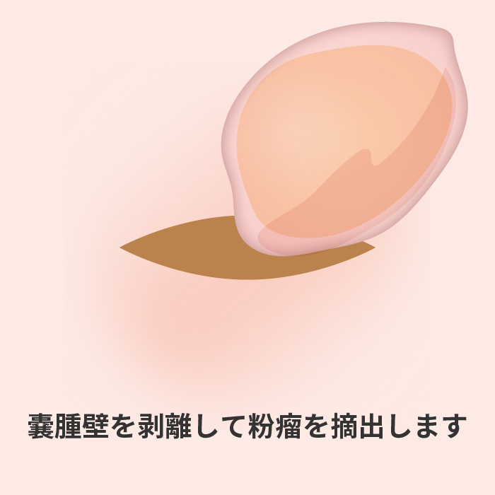 嚢腫壁を剥離して粉瘤を摘出します